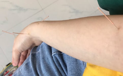 中醫有哪些針灸美容的方法